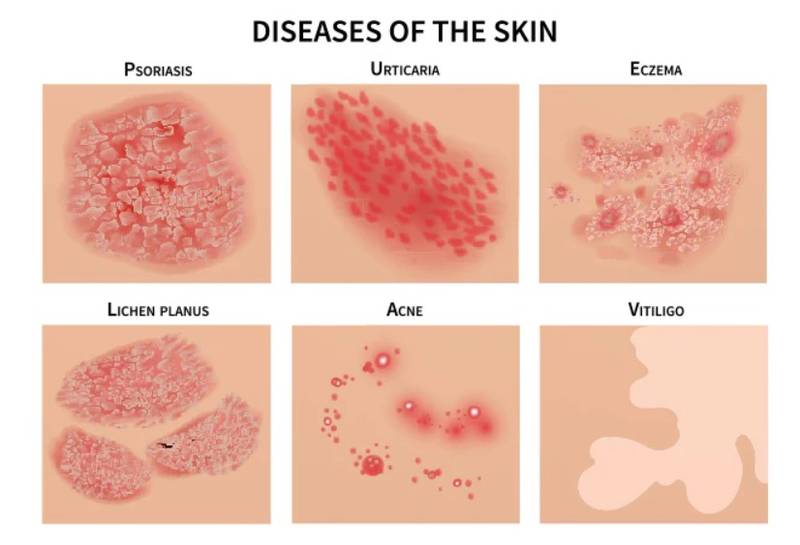 Skin diseases